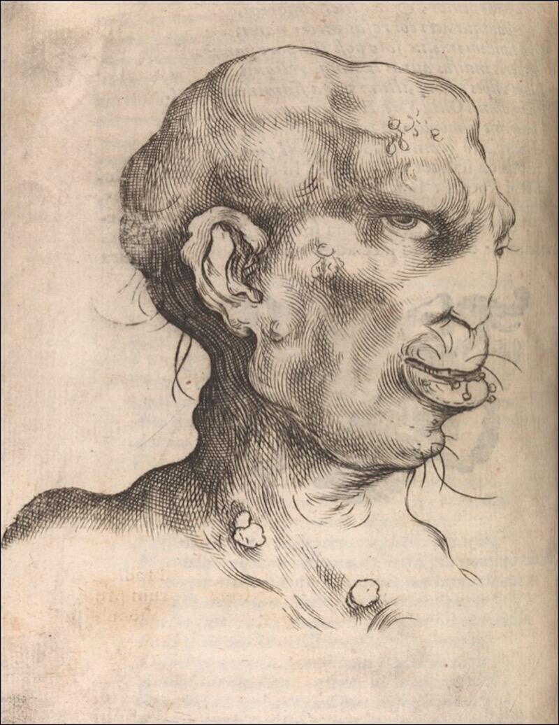An image of a man with syphilis, looking sideways at the viewer